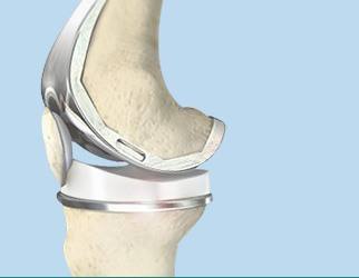 joint Replacement