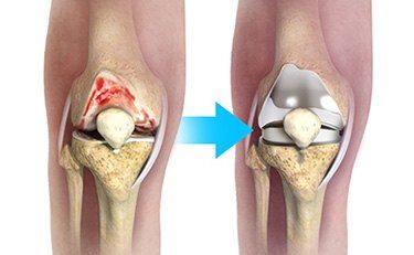 knee joint replacemnt