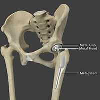 Total Hip Replacement