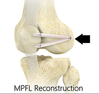 Medial Patellofemoral Ligament Reconstruction