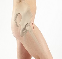 Minimally Invasive Total Hip Replacement